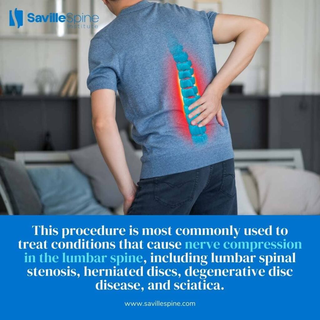 1767994238_Minimally-Invasive-Lumbar-Decompression_Laminectomy-B Minimally Invasive Lumbar Decompression_Laminectomy