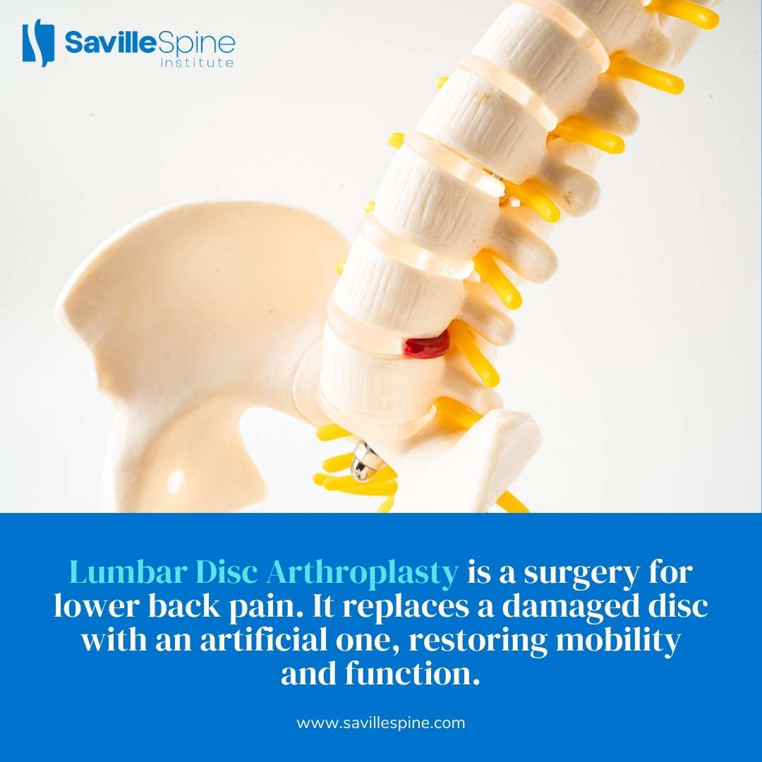 Recovery Timeline After Lumbar Disc Arthroplasty